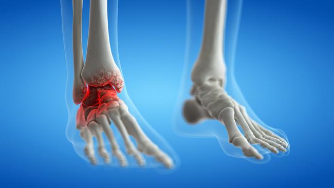 Understanding Ankle Arthritis and Non-Surgical Options for Treatment