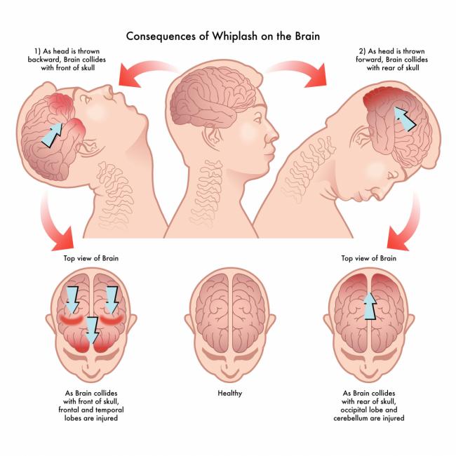 What Is Whiplash and What Are the Symptoms of Severe Whiplash?